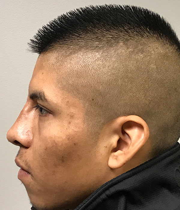 Non Surgical Rhinoplasty 03