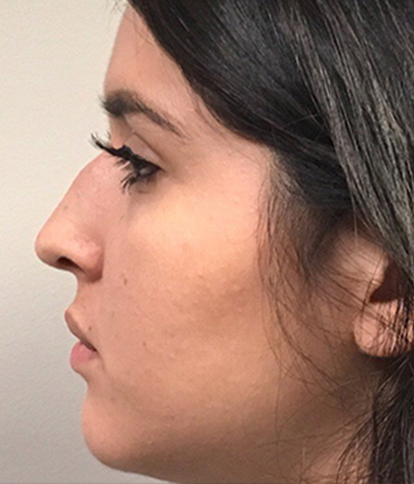 Non Surgical Rhinoplasty 01