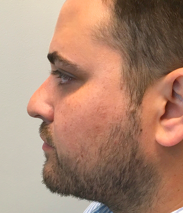 Non Surgical Rhinoplasty 01