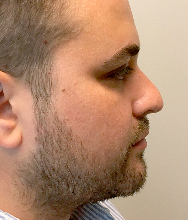 Non Surgical Rhinoplasty 03