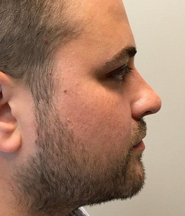 Non Surgical Rhinoplasty 03