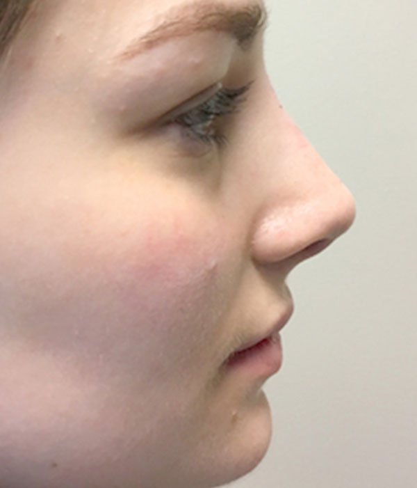 Non Surgical Rhinoplasty 19