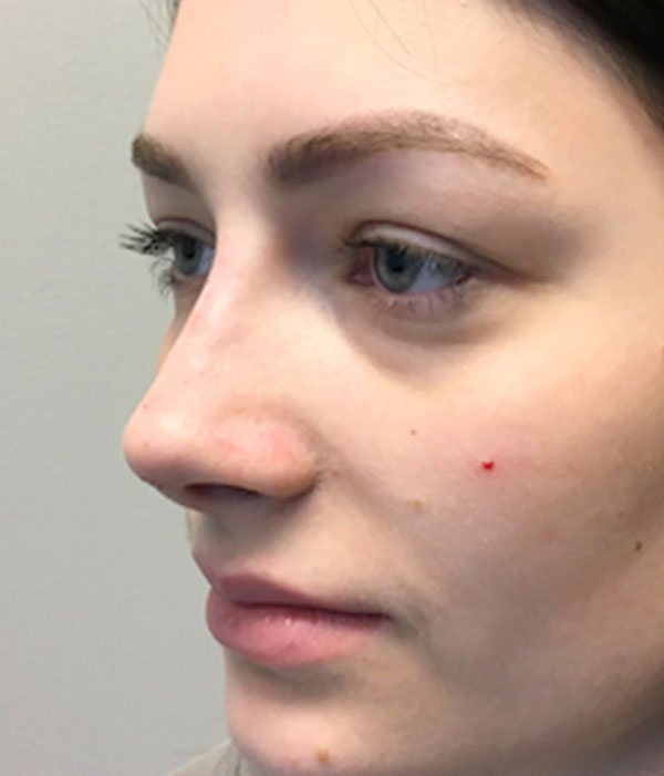 Non Surgical Rhinoplasty 03