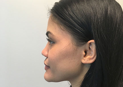 Non Surgical Rhinoplasty 03