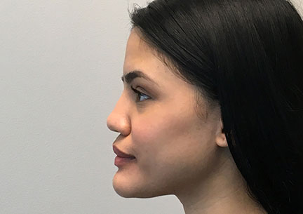 Non Surgical Rhinoplasty 03