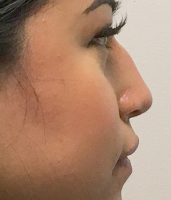 Non Surgical Rhinoplasty 05