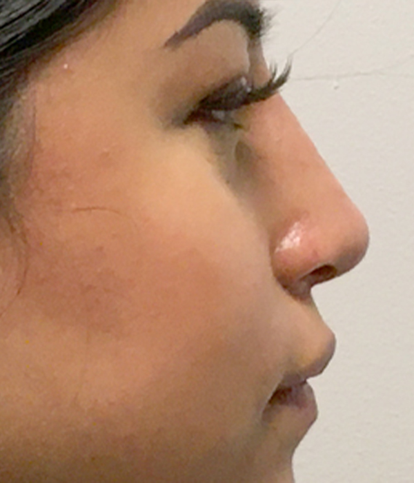 Non Surgical Rhinoplasty 05
