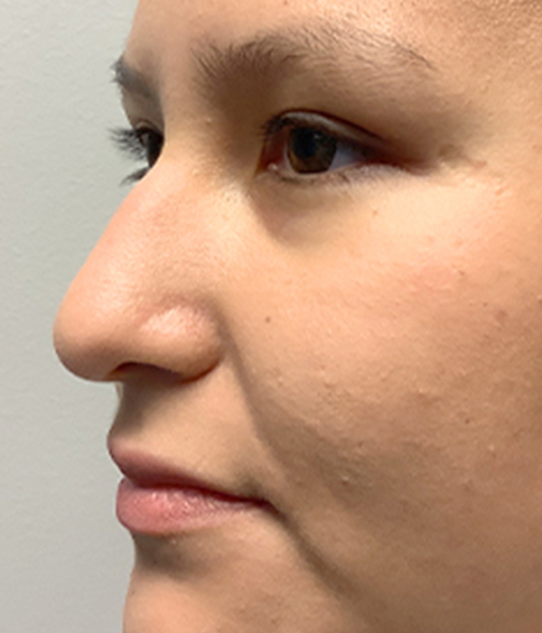 Non Surgical Rhinoplasty 01