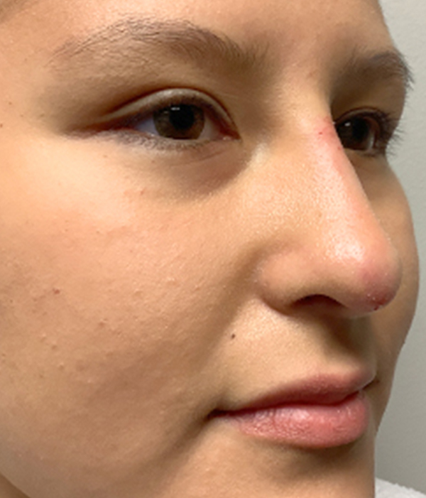 Non Surgical Rhinoplasty 05