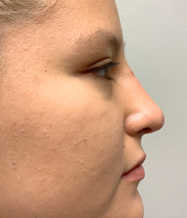 Non Surgical Rhinoplasty 07