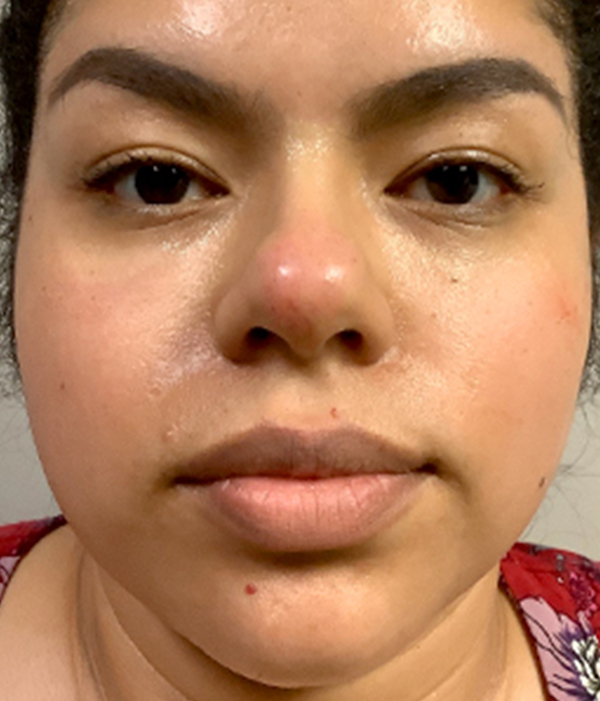 Non Surgical Rhinoplasty 23