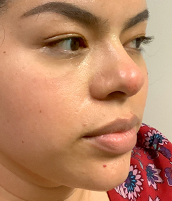 Non Surgical Rhinoplasty 03