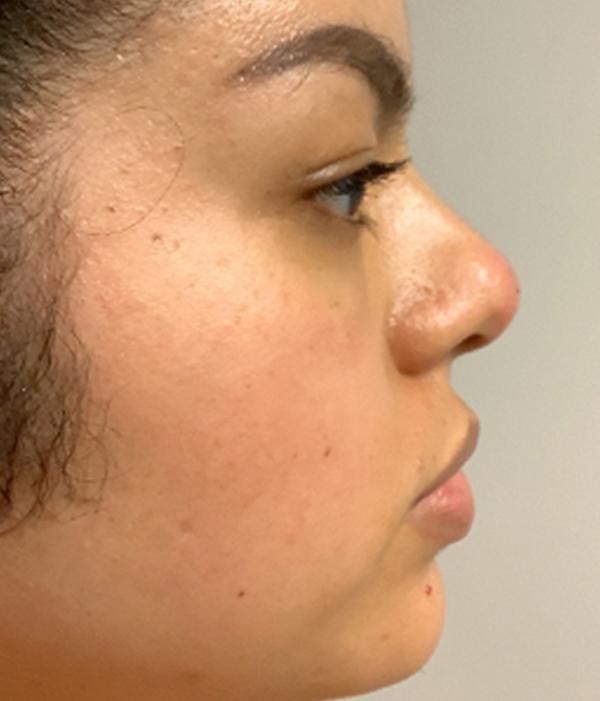 Non Surgical Rhinoplasty 05
