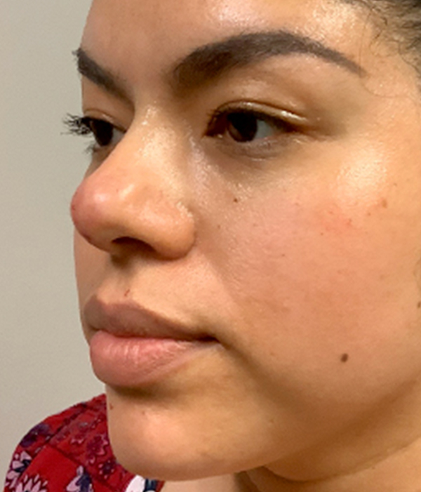 Non Surgical Rhinoplasty 07