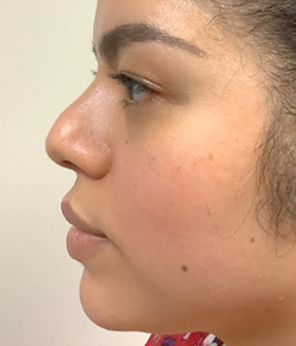Non Surgical Rhinoplasty 09