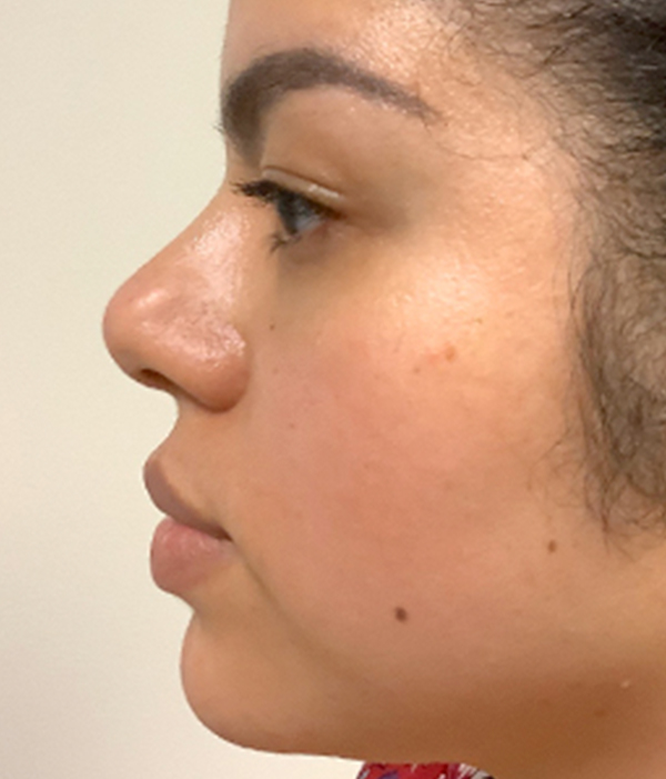 Non Surgical Rhinoplasty 09