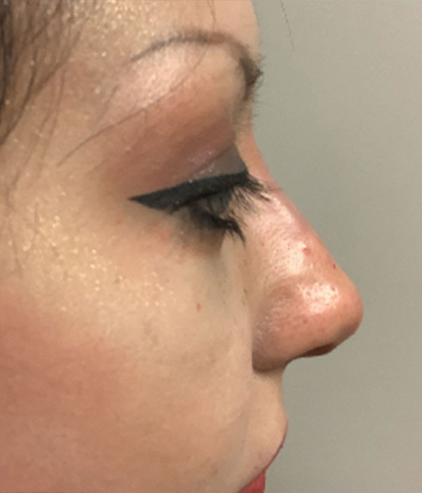 Non Surgical Rhinoplasty 24