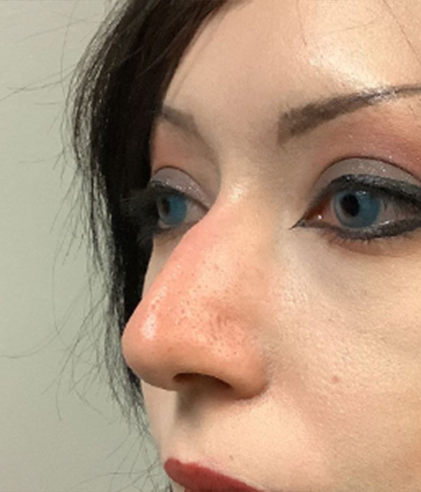 Non Surgical Rhinoplasty 05