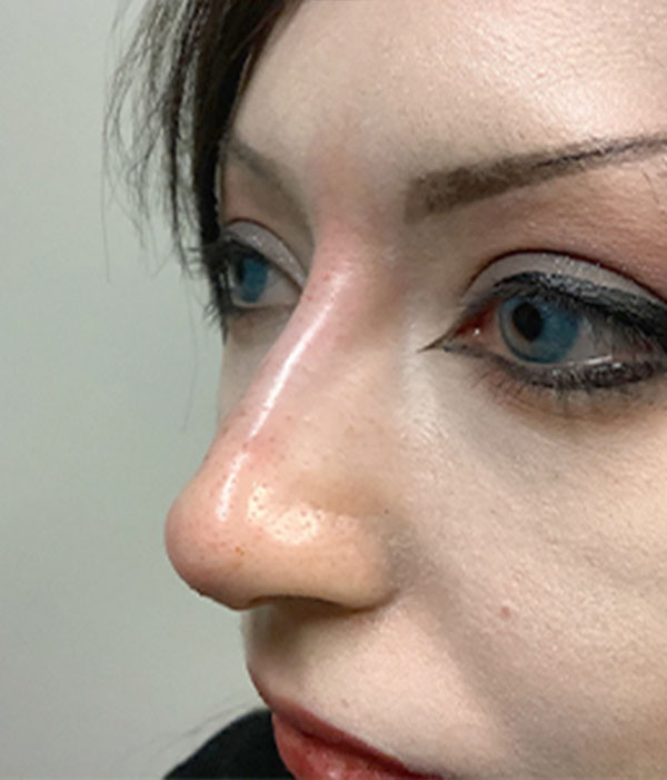 Non Surgical Rhinoplasty 05