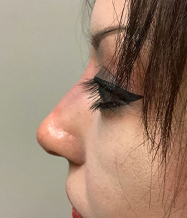 Non Surgical Rhinoplasty 07