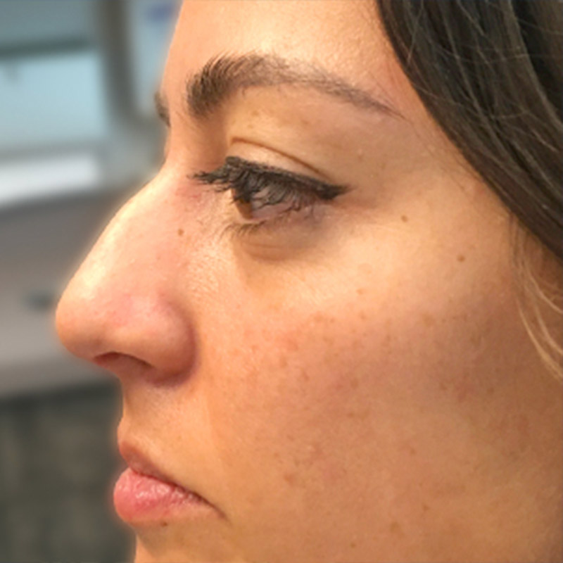 Non Surgical Rhinoplasty 01