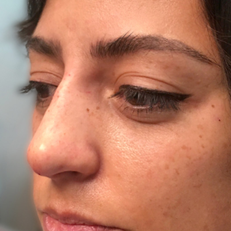 Non Surgical Rhinoplasty 03