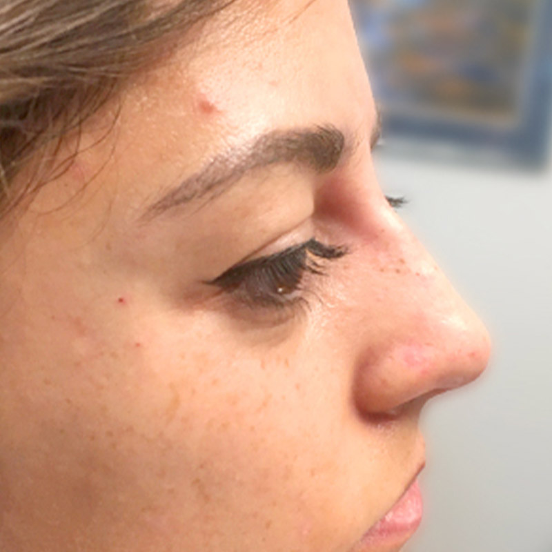 Non Surgical Rhinoplasty 05