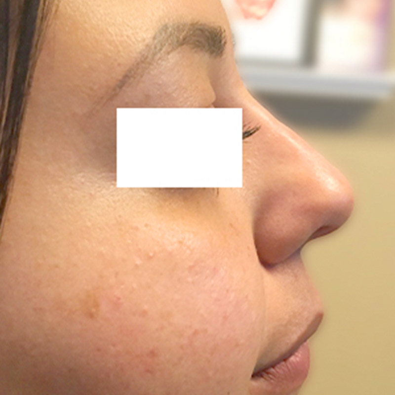 Non Surgical Rhinoplasty 26