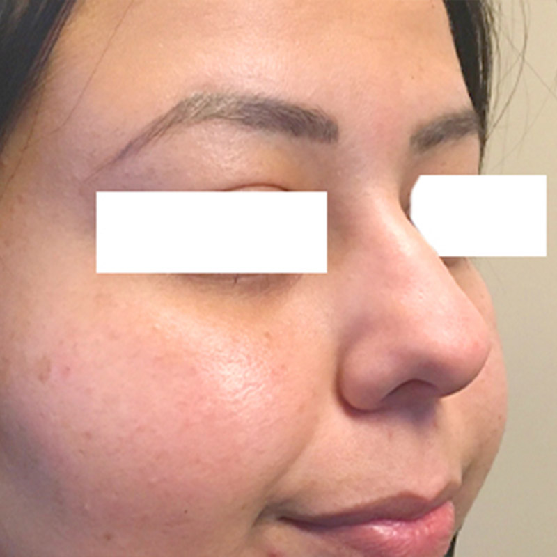 Non Surgical Rhinoplasty 03