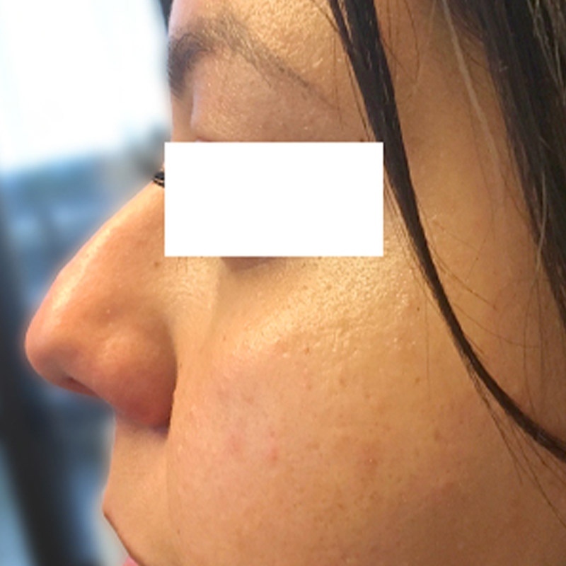 Non Surgical Rhinoplasty 07