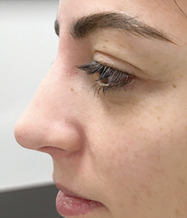 Non Surgical Rhinoplasty 27