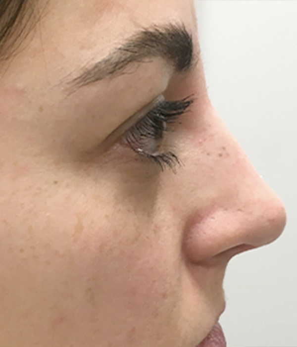Non Surgical Rhinoplasty 03