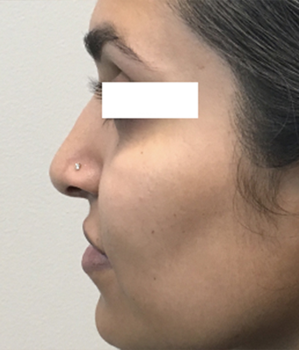 Non Surgical Rhinoplasty 01