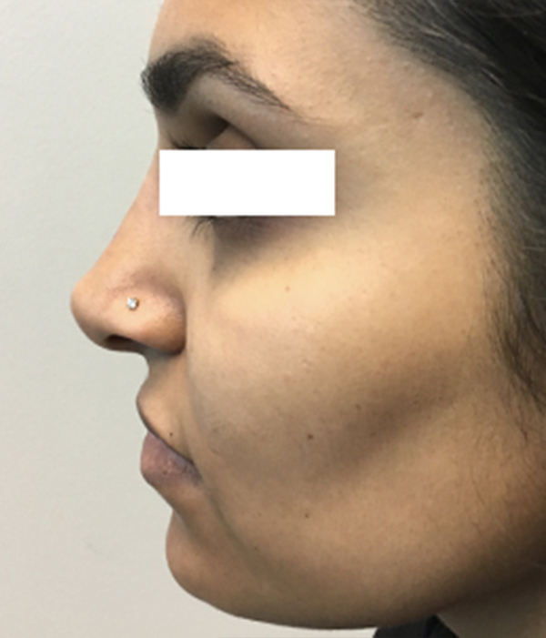 Non Surgical Rhinoplasty 28