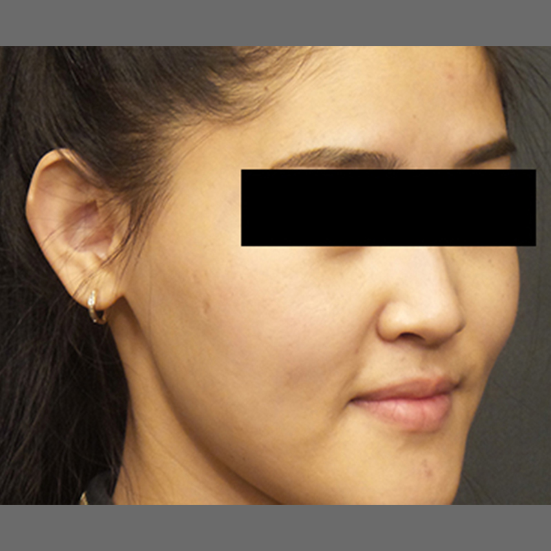 Otoplasty 03