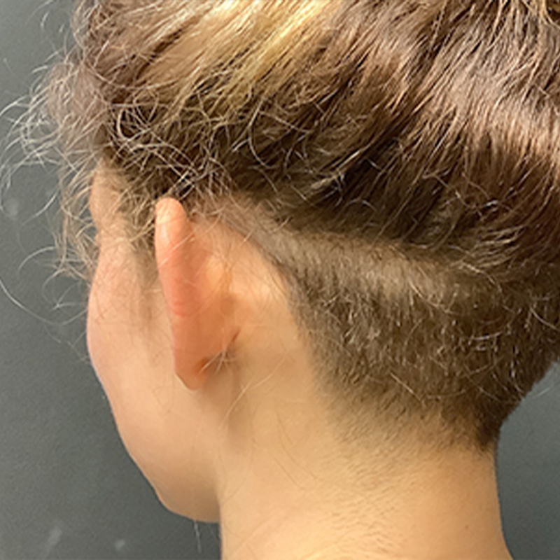 Otoplasty 05