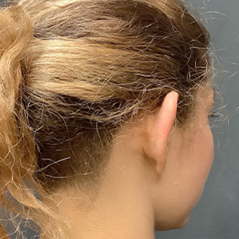 Otoplasty 07