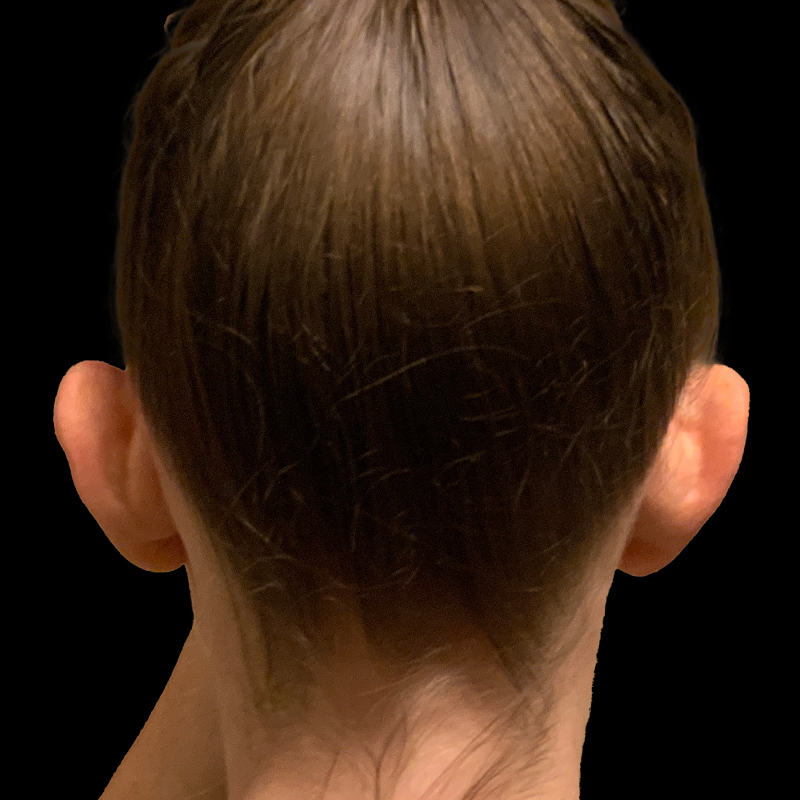 Otoplasty 03