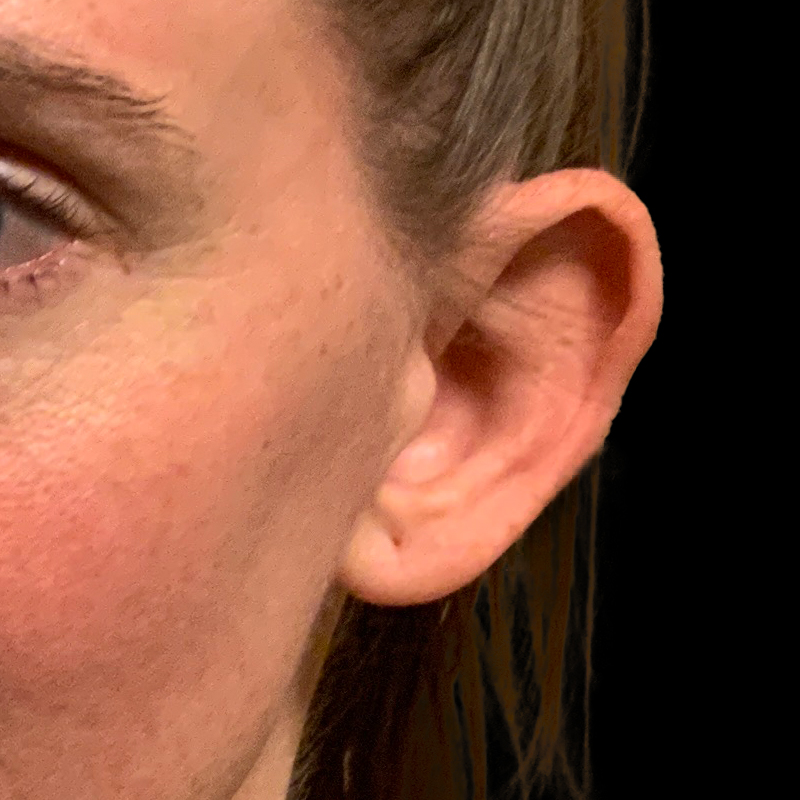 Otoplasty 05