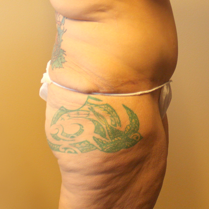 Posterior Body Lift 03