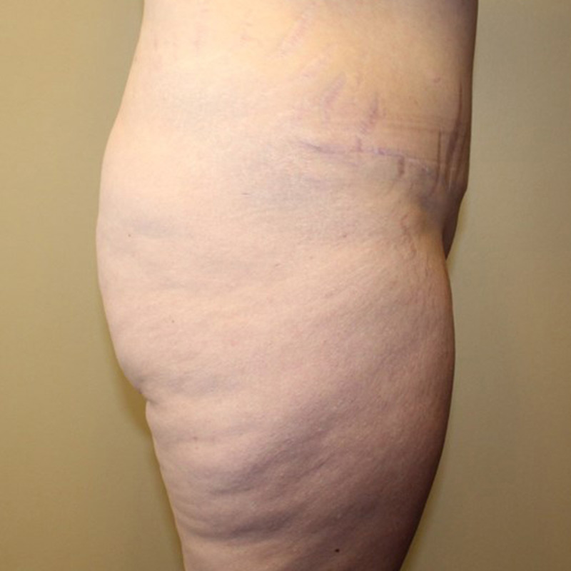 Posterior Body Lift 03