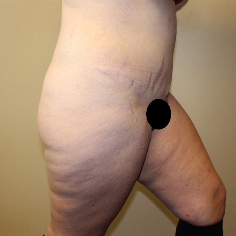 Posterior Body Lift 05