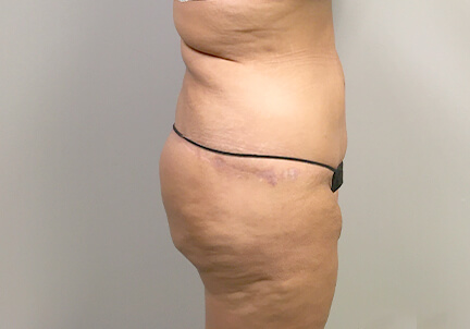 Posterior Body Lift 01