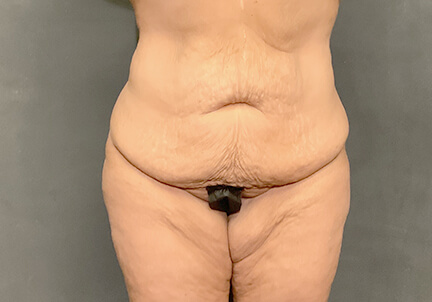 Posterior Body Lift 03