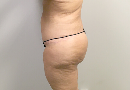 Posterior Body Lift 05