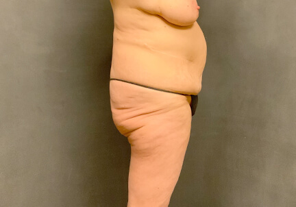 Posterior Body Lift 01