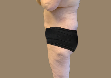 Posterior Body Lift 03