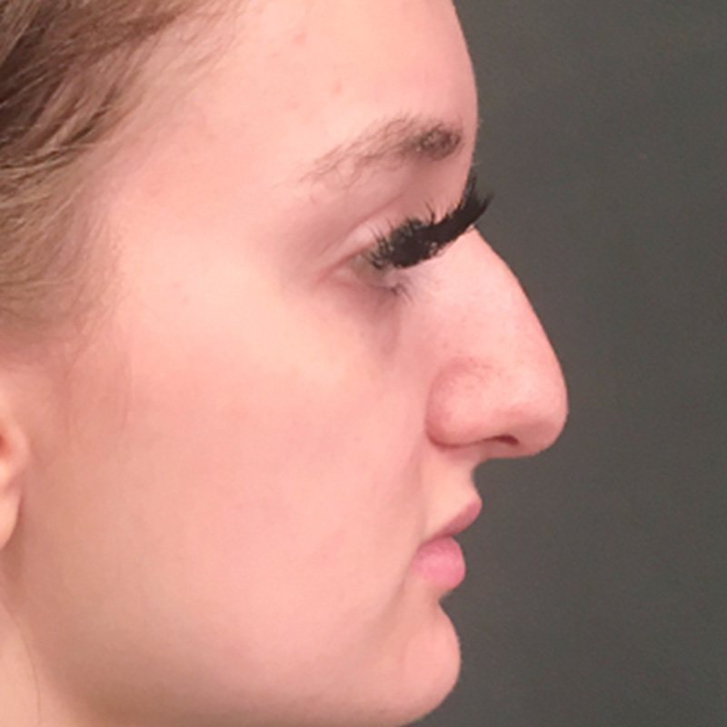 Rhinoplasty 01
