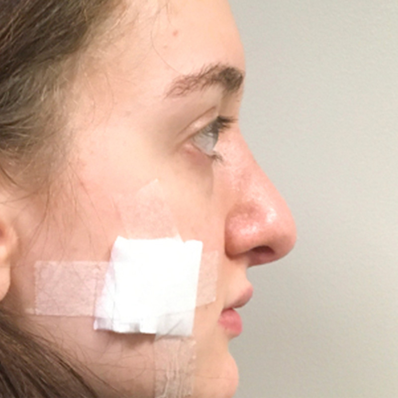 Rhinoplasty 04