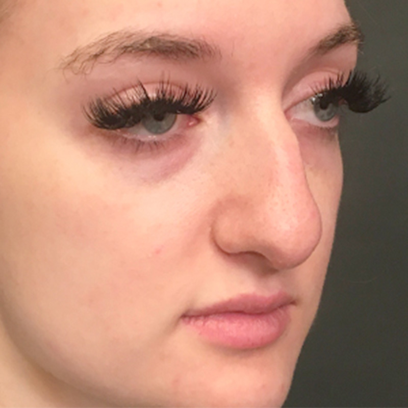Rhinoplasty 03